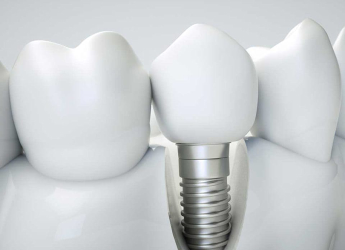 Имплантация зубов